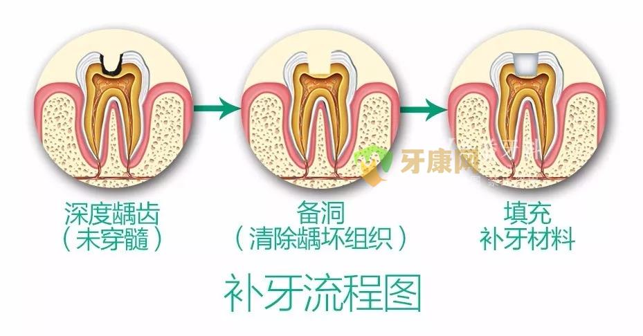 补牙流程