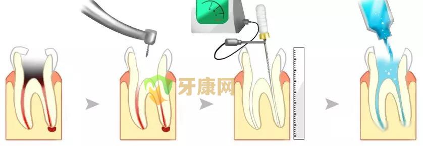 根管治疗