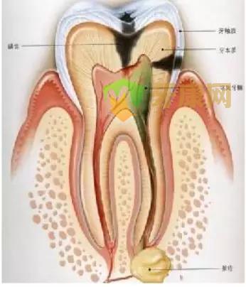 根尖周炎