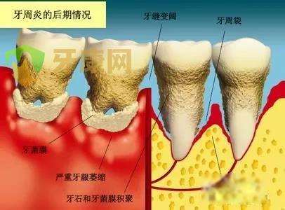 牙周病