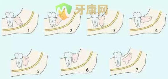 深圳哪个医院拔智齿便宜一点？