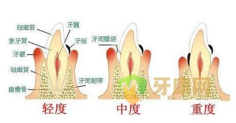 牙健网牙周炎发展过程