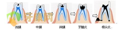 补牙需要多长时间