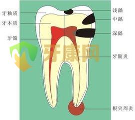 牙根尖周炎的治疗方法有哪些？