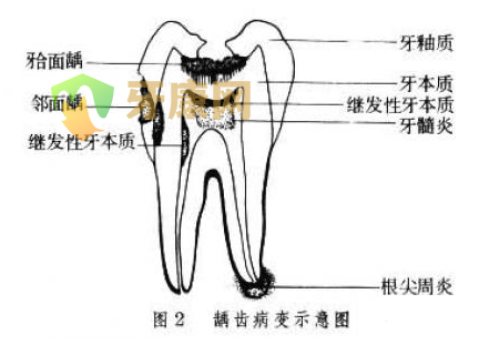 得了根尖周炎怎么办？