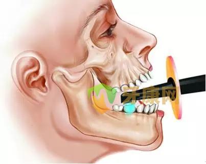 深圳光固化树脂补牙收费价格是怎样的