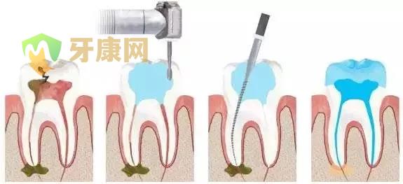 根管治疗