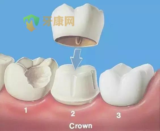 根管治疗