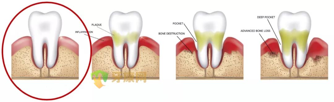 牙周病