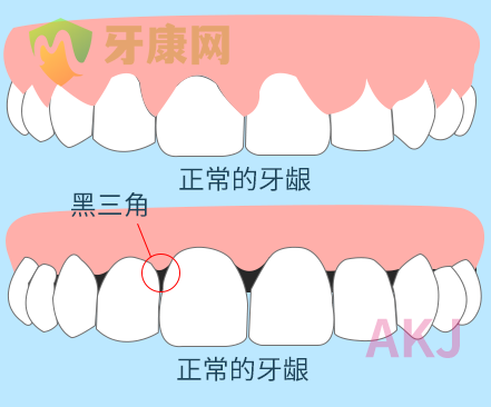 黑三角