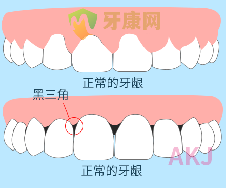 牙龈萎缩