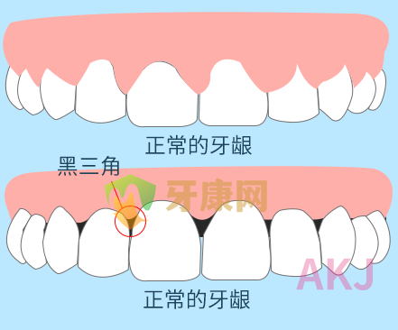 牙龈萎缩