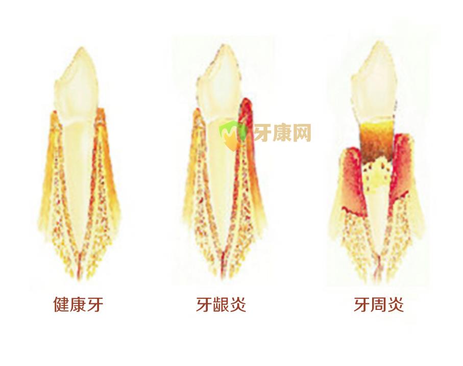 牙周炎