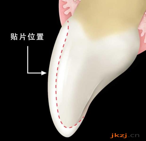 牙齿贴面磨牙