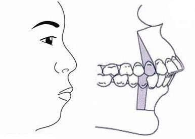 骨性龅牙矫正