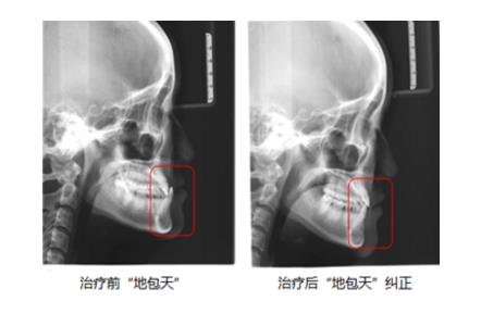 治疗前治疗后地包天