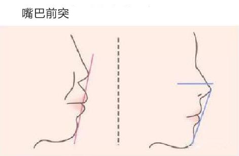 24岁嘴巴前凸需要整牙吗