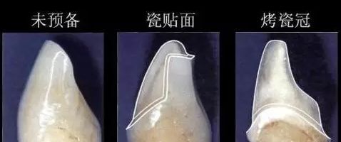 瓷贴面和烤瓷牙备牙量**图