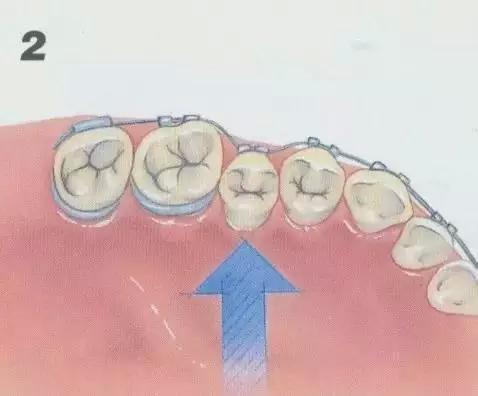 牙齿不齐矫正