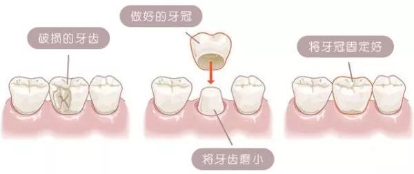 烤瓷牙修复示意图