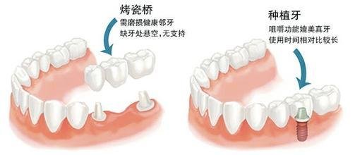 牙齿缺失后种牙和烤瓷牙的区别