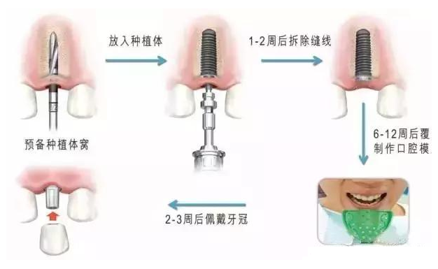 牙齿缺失后，做哪种假牙好