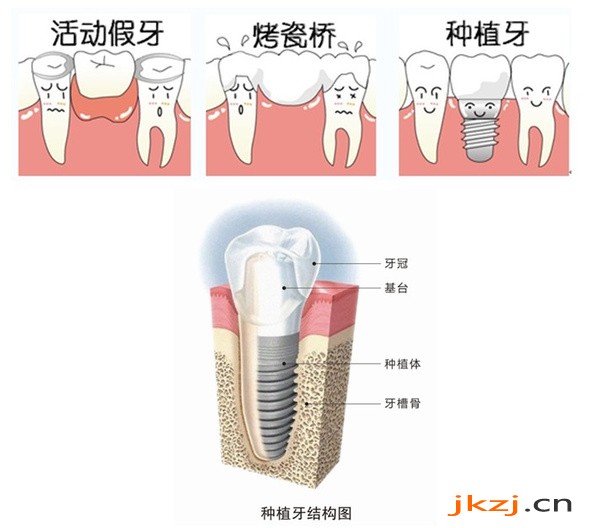 镶一颗牙齿多少钱