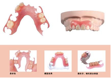 镶活动义齿修复