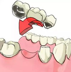 烤瓷牙修复不拔牙要磨牙