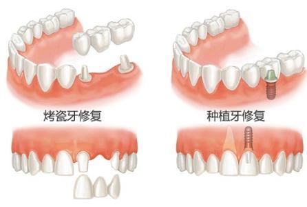 医院镶牙多少钱