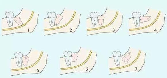 常见的几种智齿生长样子图片