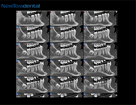 种植牙拍摄CT
