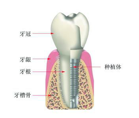 种一颗牙齿的费用