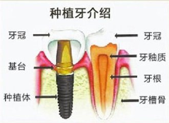 种植牙结构介绍