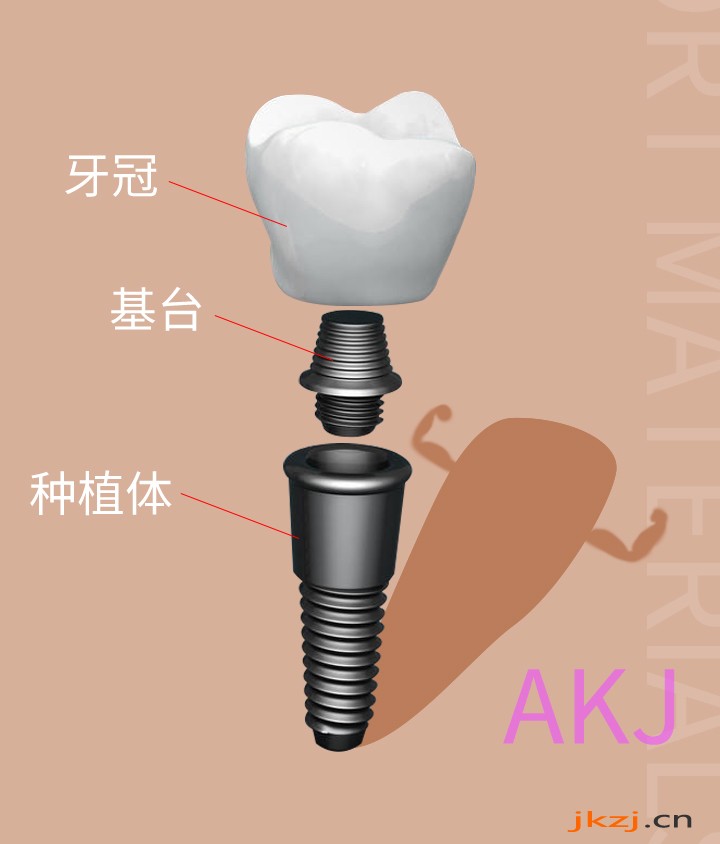 种植牙由哪几部分组成
