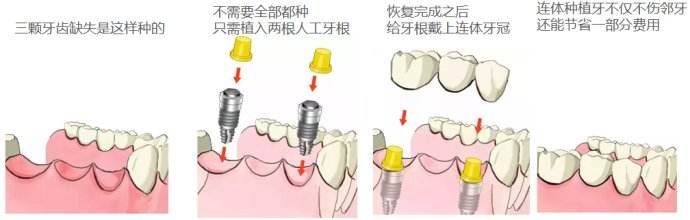 三颗牙齿连续缺失