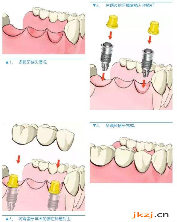 连续三颗牙齿缺失怎么做种植牙