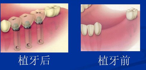 颗种植牙的步骤
