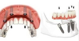 4颗种植体修复半口种植牙