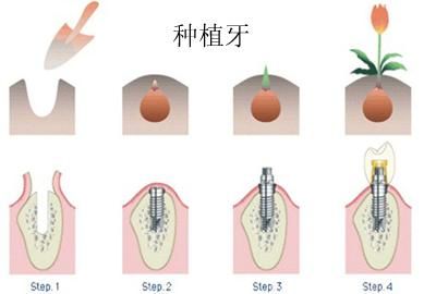 半口种植牙