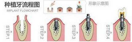 全口种植牙过程图