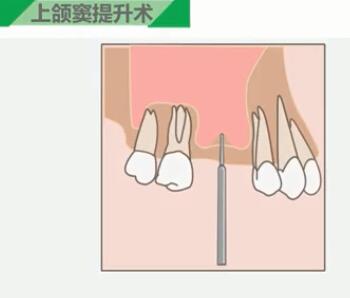 上颌窦提升