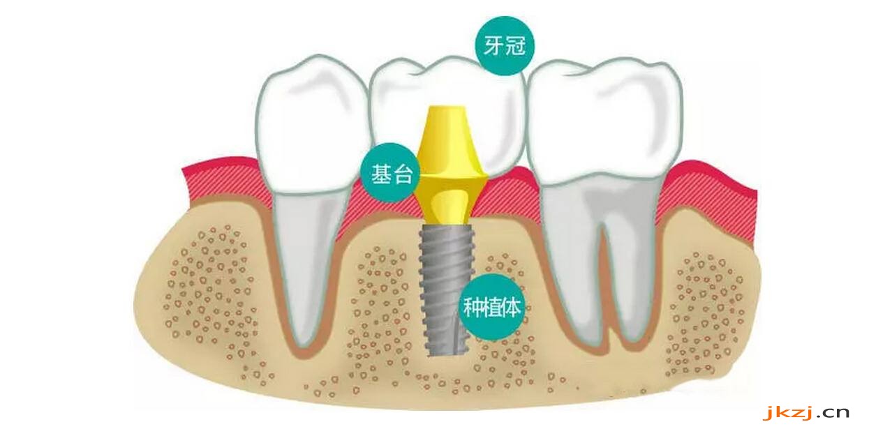 种植牙结构