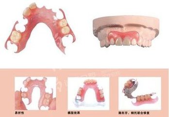 活动假牙的价格