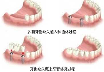 种植一颗牙齿要多少钱