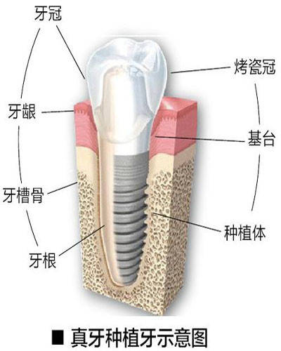 真牙和种植牙示意图