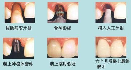 人工种植牙的成功率高吗