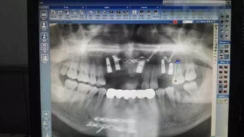 种植牙的术前检查