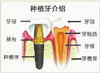 下门牙种植牙