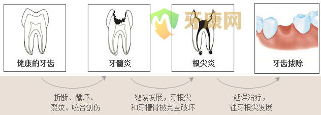 乳牙治疗